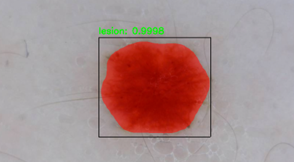 Utilize a Mask R-CNN to automatically segment skin lesions for cancer identification using Mask R-CNN