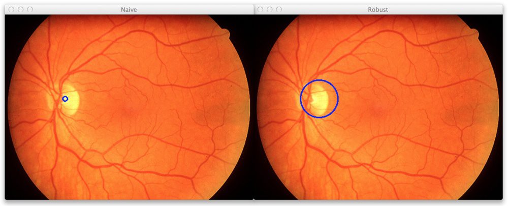 Figure 1: Detecting the brightest area of a retinal image using our naive and robust methods. The results are good and look quite similar.