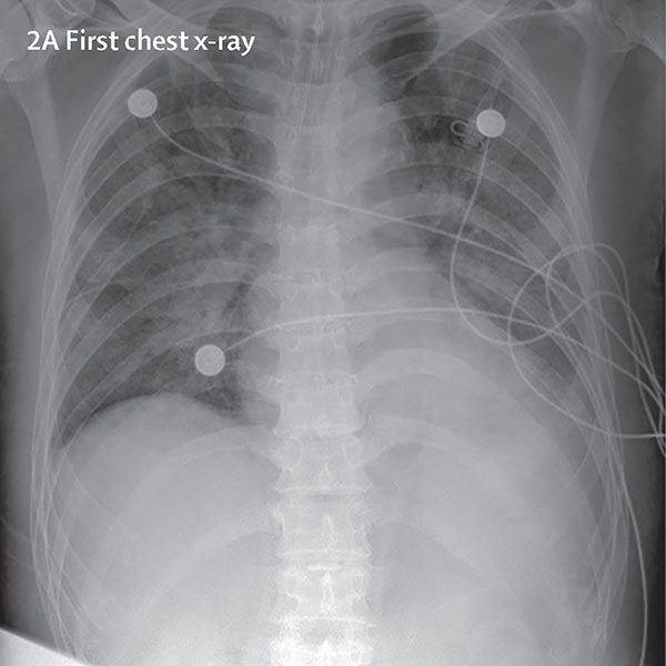 Detecting Covid 19 In X Ray Images With Keras Tensorflow And